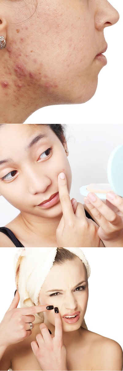 acne-questions-answered