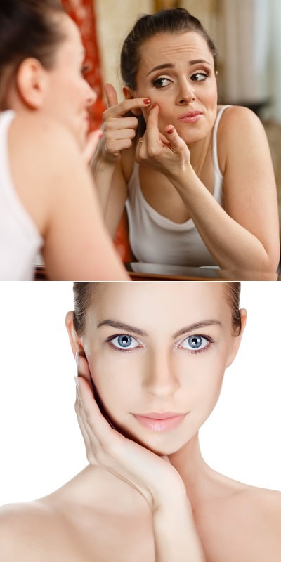 clear-skin-for-acne