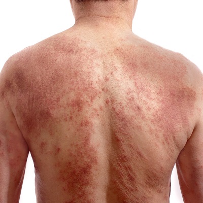 psoriasis_1_400x400