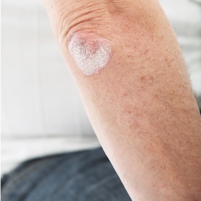 psoriasis_2_400x400
