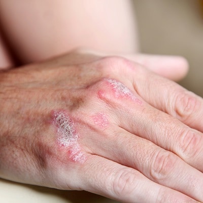 psoriasis_3_400x400