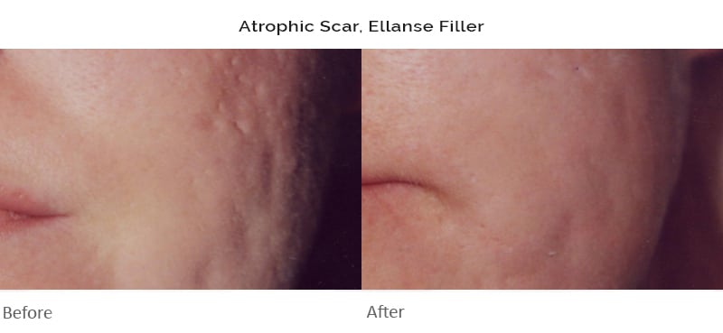 Acne scar treatment london