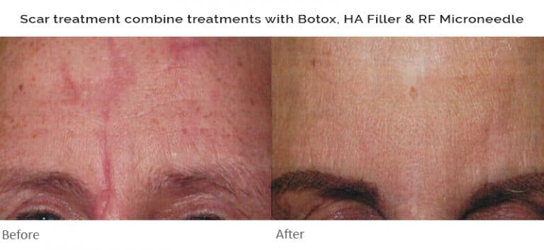 Scar Treatment Clinic - Cranley Clinic