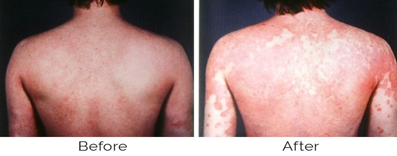 ipl for psoriasis)