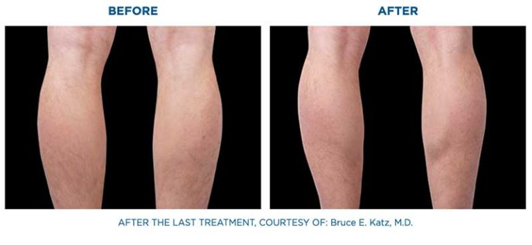 emsculpt neo before and after emsculpt neo before and after