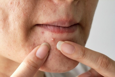Acne squeeze spot