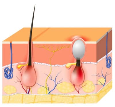 What Causes Acne