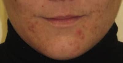 Young Woman Acne