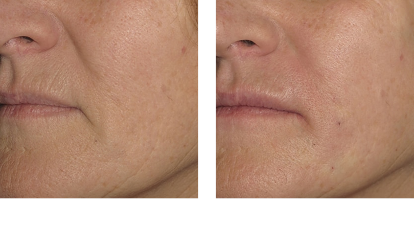 Fillers Lips 2