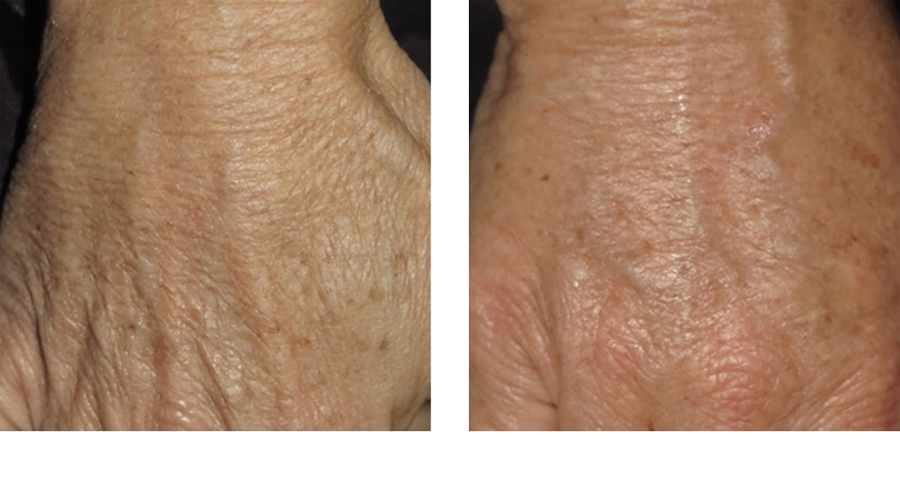Fillers Hand