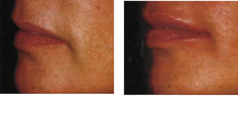 Fillers Lips