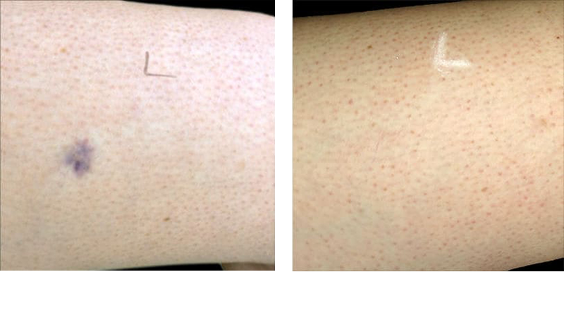 Sclerotherapy