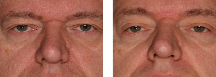 Sofwave Before and After