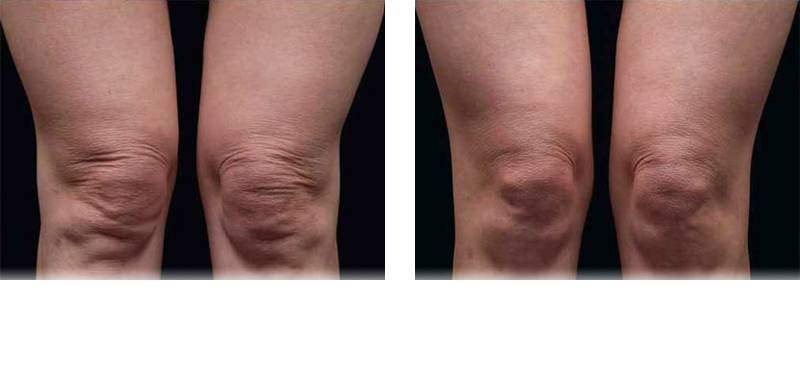 Thermage Knees