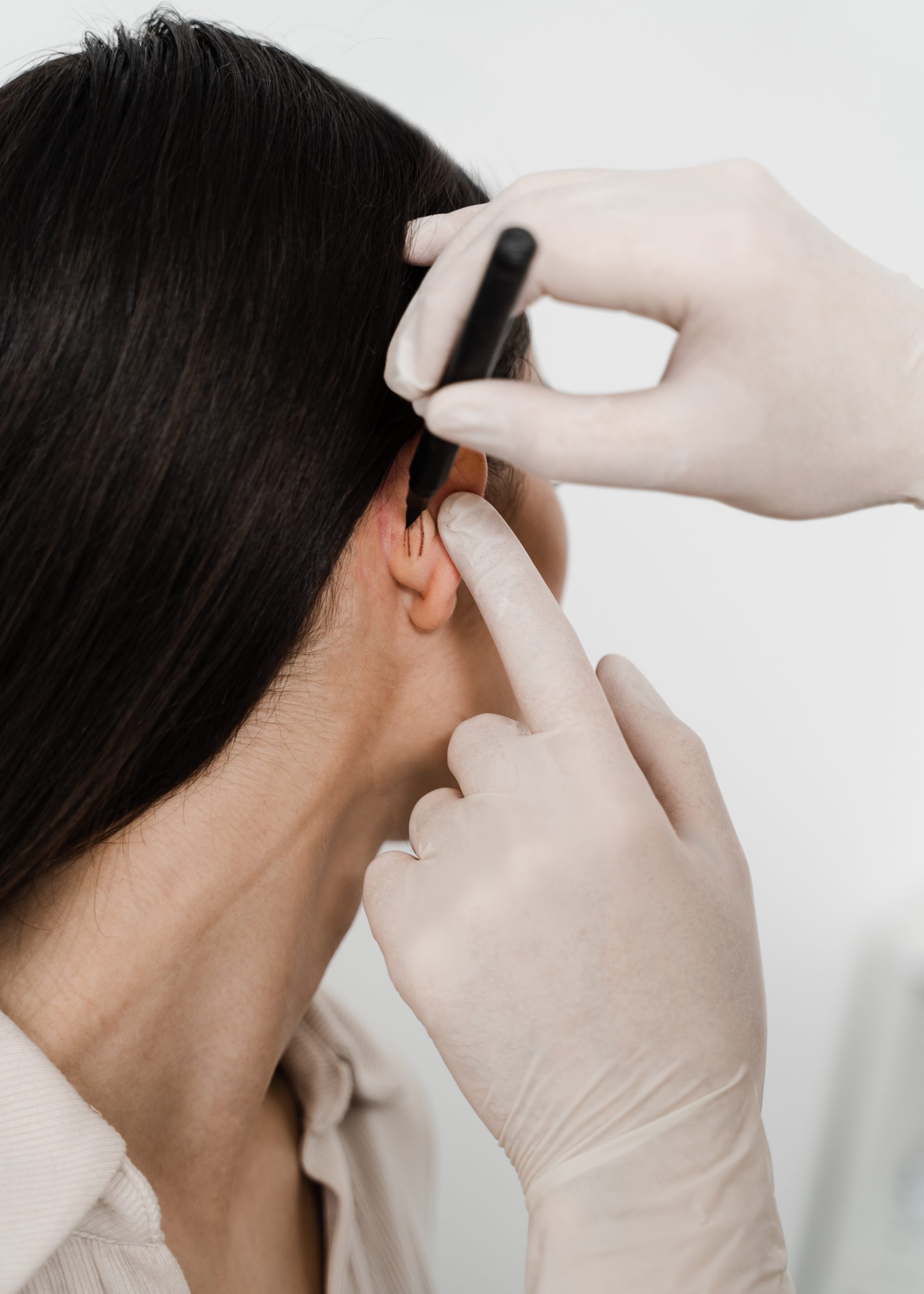 Surgeon draw marking on ear before otoplasty cosmetic surgery. Otoplasty markup before ear surgery. Otoplasty mark-up for surgical reshaping of pinna and ear. Surgeon draw marking on ear before otoplasty cosmetic surgery. Otoplasty markup before ear surgery. Otoplasty mark-up for surgical reshaping of pinna and ear.